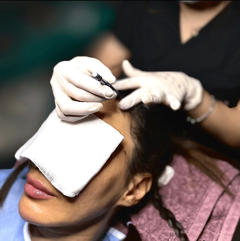 Haartransplantation Bei Frauen Kosten Istanbul T Rkei Quartz Clinique