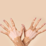 vitiligo tedavisi