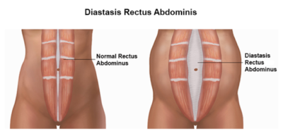Diastasis Recti Treatment