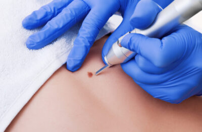 Electrosurgery For Skin Lesions