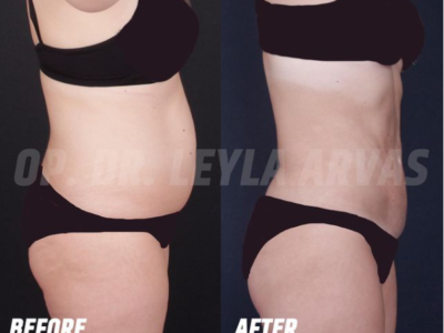 Liposuction (Fat Removal)
