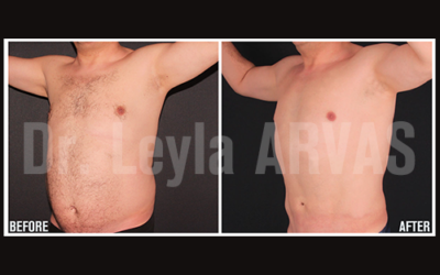 Abdominal And Stomach Liposuction