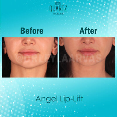 Lip Lift Surgery