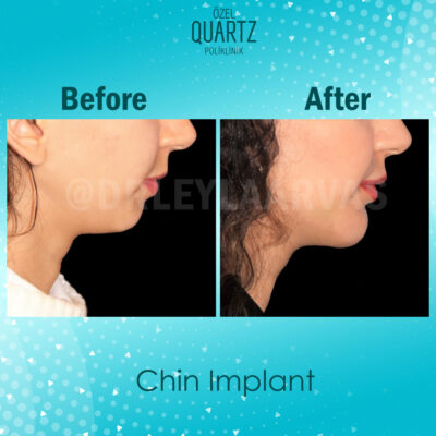 Chin Implant Surgery