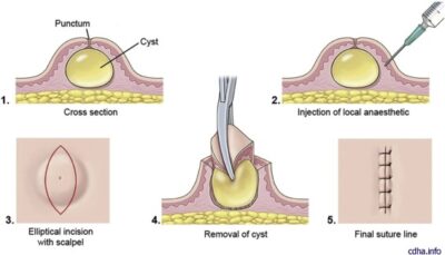 Sebaceous Cyst Treatment