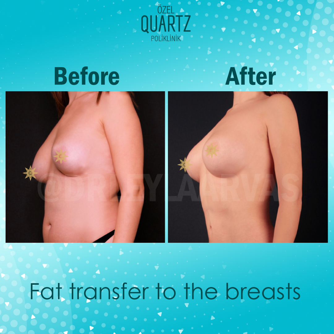 Breast Fat Transfer - Price - Istanbul, Turkey - Quartz Clinique