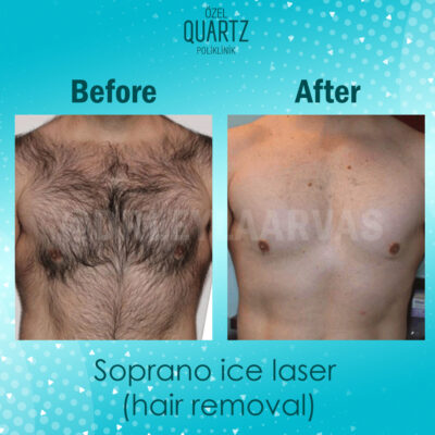 Permanent Hair Removal