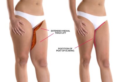 Thigh Liposuction