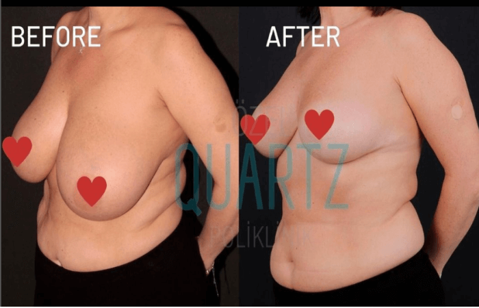 تصغير الثدي للنساء