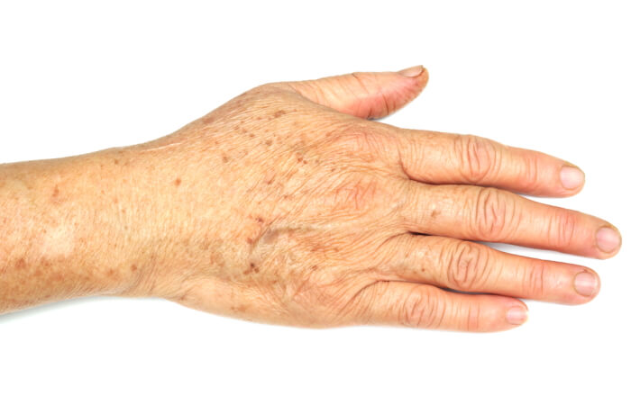 علاج البقع البنية على اليدين