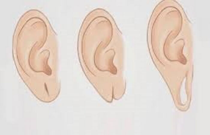 علاج قطع شحمة الأذن