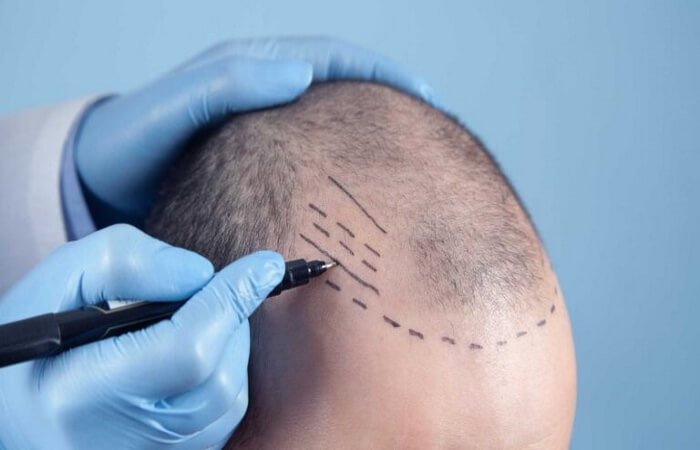 ماهي تقنية FUE لزراعة الشعر