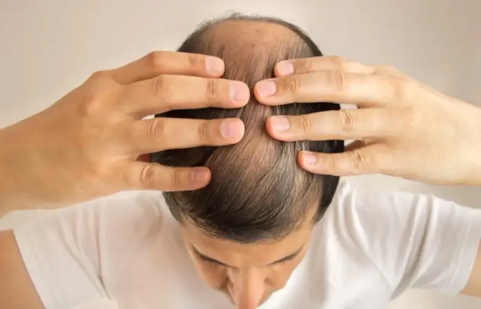 مينوكسيديل لعلاج تساقط الشعر