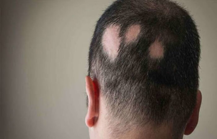 Kaip sustabdyti alopecijos plitimą?