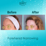 Forehead Reduction Surgery