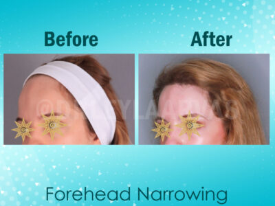 Forehead Reduction Surgery