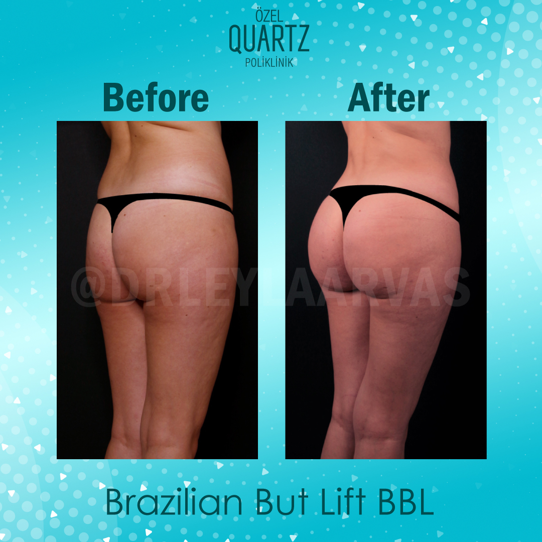Brazilian Butt Turkey, BBL Cost in Istanbul