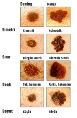 Skin Cancer Symptoms 