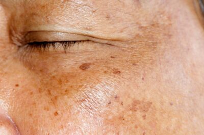 Skin Spots