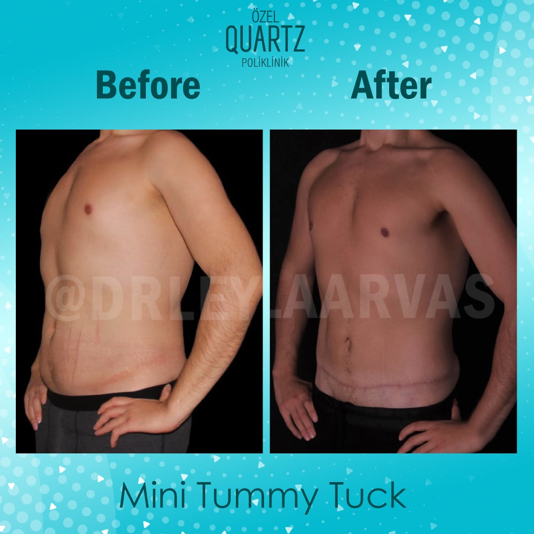 Mini Tuck And Tummy Tuck (abdominoplasty) Before & After Photos Patient 07