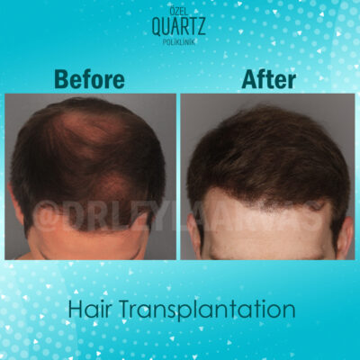 Tрансплантация Волос