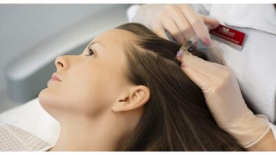 Mesotherapie Gegen Haarausfall