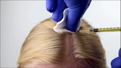 Mesotherapie Gegen Haarausfall